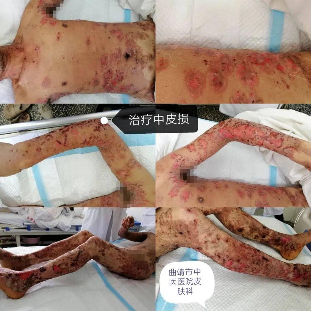 请慎(为保护患者隐私,脸部进行马赛克处理)此例患者为大疱性类天疱疮