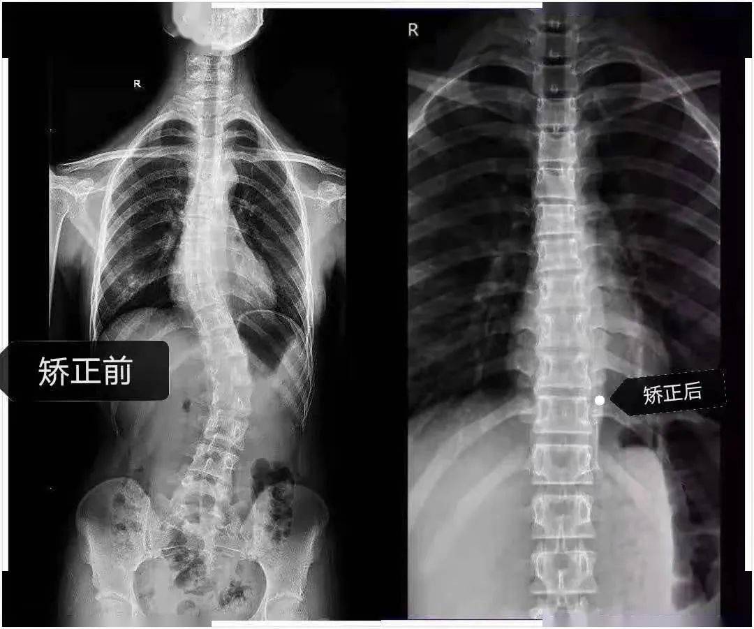 脊柱侧弯矫正前后许昌儿童医院康复科寒假青少年形体训练班开班啦,让