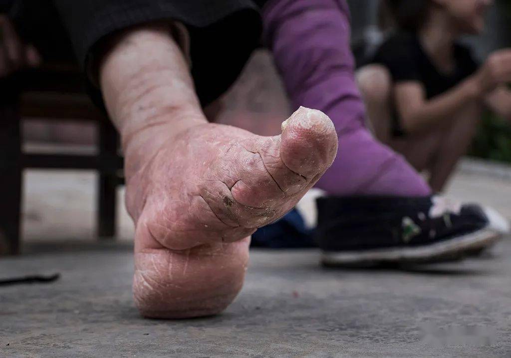 近几年,小脚老人越来越少,在通海六一,长河,五脑山等地健康的生活着几