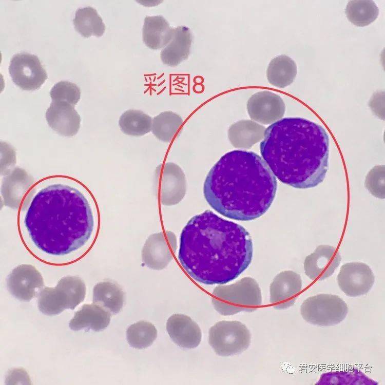 ▼「原始淋巴细胞」形态特征:胞体类圆形,胞质量较少,呈透明的天蓝色