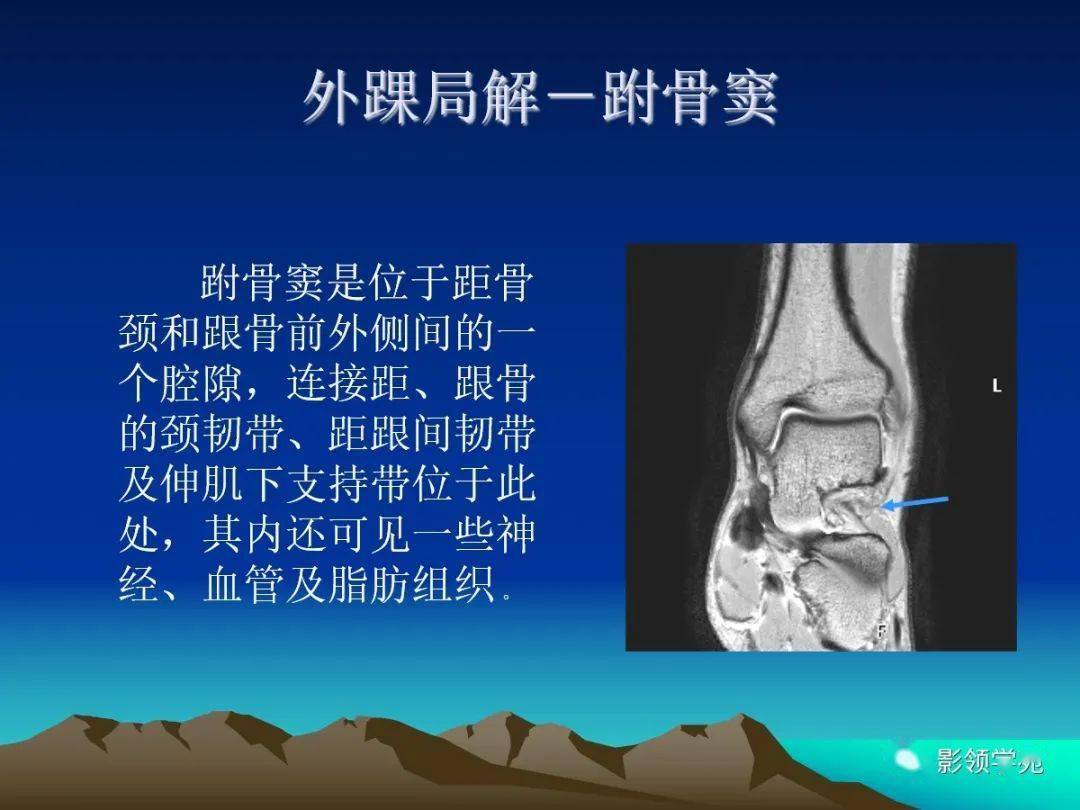 踝關節外側韌帶急性損傷的mri表現