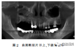 双膦酸盐导致上下颌骨大面积坏死病例报道