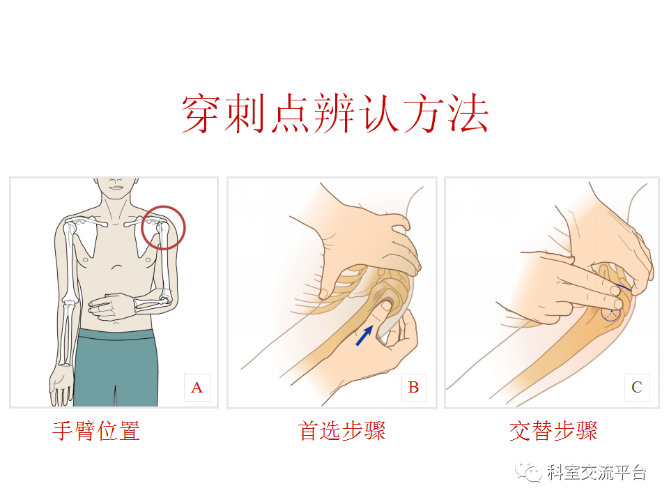 跟骨骨刺封闭注射位置图片