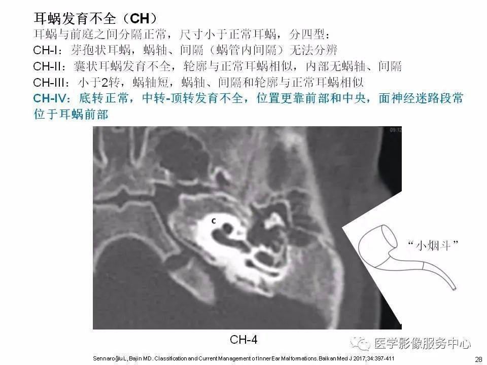 主要基于mri第二部分:内耳畸形分类,主要基于ct第一部分:耳蜗解剖