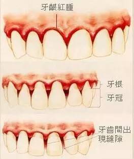 牙周病的五步治疗法
