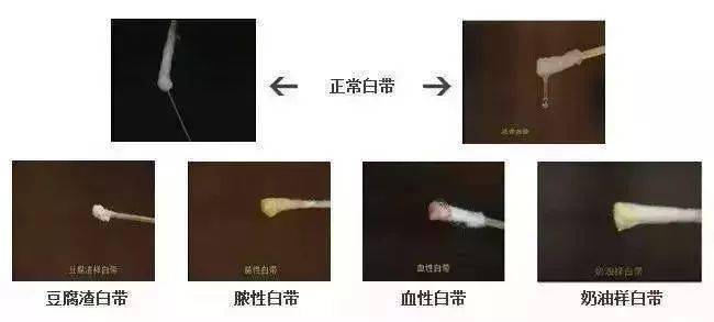 白带有血丝，千万别掉以轻心！是这些疾病的征兆！