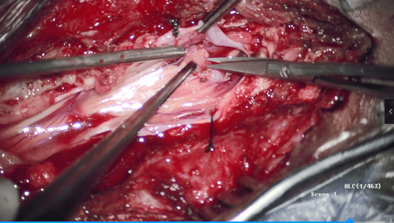 【病例分享】齐鲁医院江玉泉教授团队:脊髓纵裂畸形手术病例分享