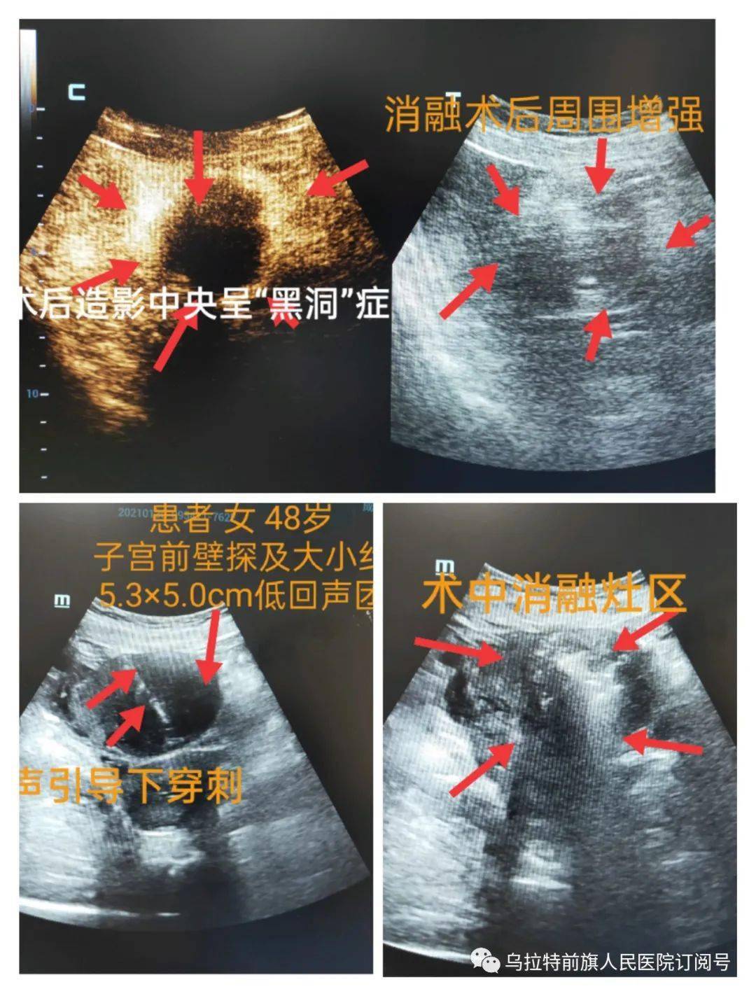 我院成功开展首例超声引导下子宫肌瘤微波消融术67