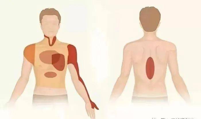 心绞痛 放射图片