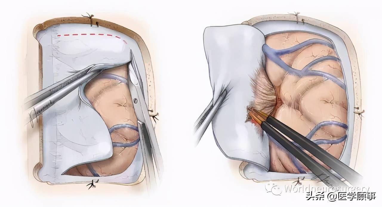 开颅手术的过程图片