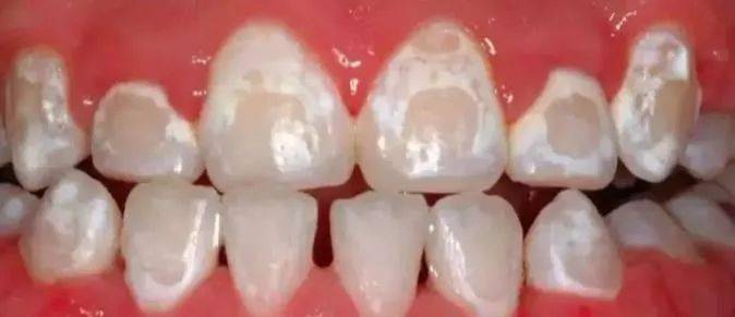 宝宝牙齿出现白斑妈妈们赶紧了解一下乳牙脱矿