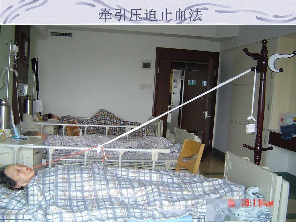 三腔二囊管的应用及护理