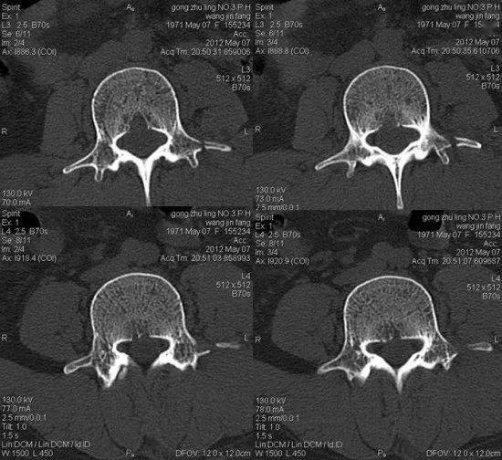 腰椎左側橫突骨折l2椎體爆裂骨折骶骨右翼及雙側坐骨支骨折02病理性