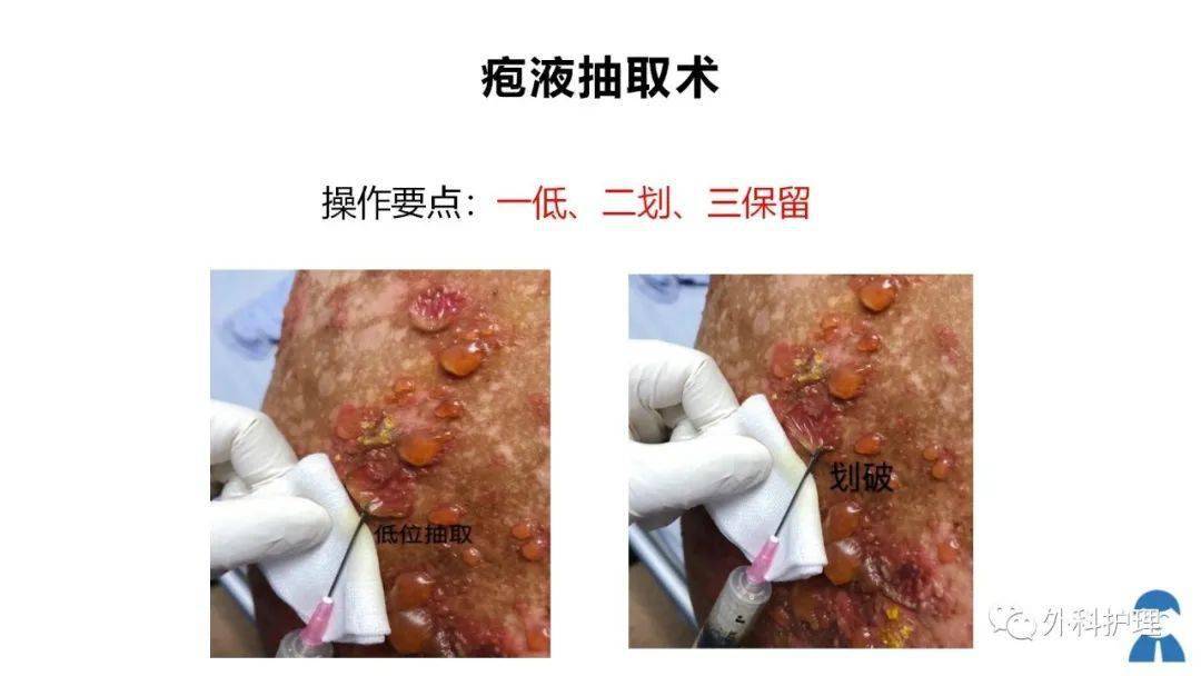 天疱疮图片治疗方法图片