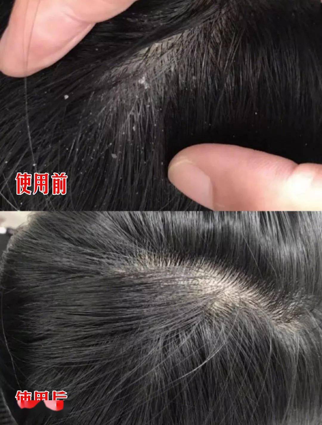 自己在家怎么清理头皮屑 7b600cfdf96b4033a031f2ae48561883.jpeg
