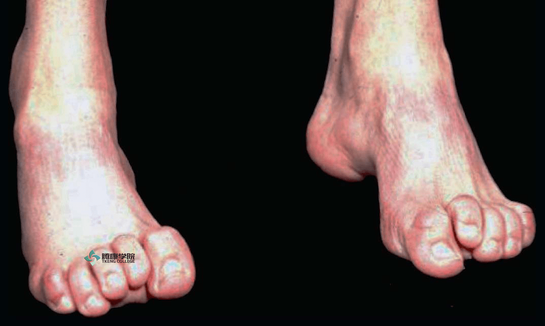 锤状趾或87指滑囊炎通常伴随着有结缔组织挛缩的其他病症,例如马蹄