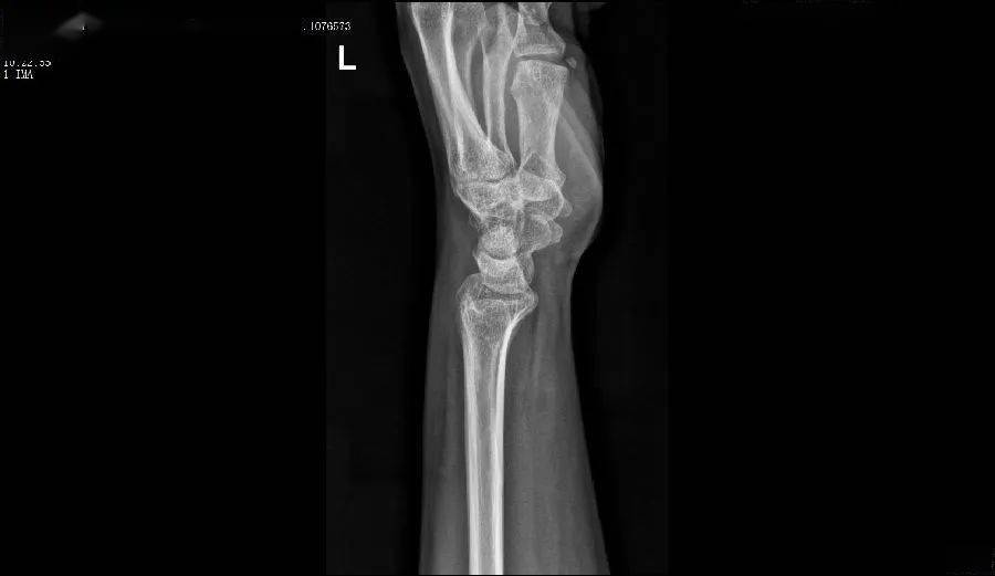 放射医学影像科赵钰获中华医学会影像医学分会腕关节dr摄影大赛三等奖