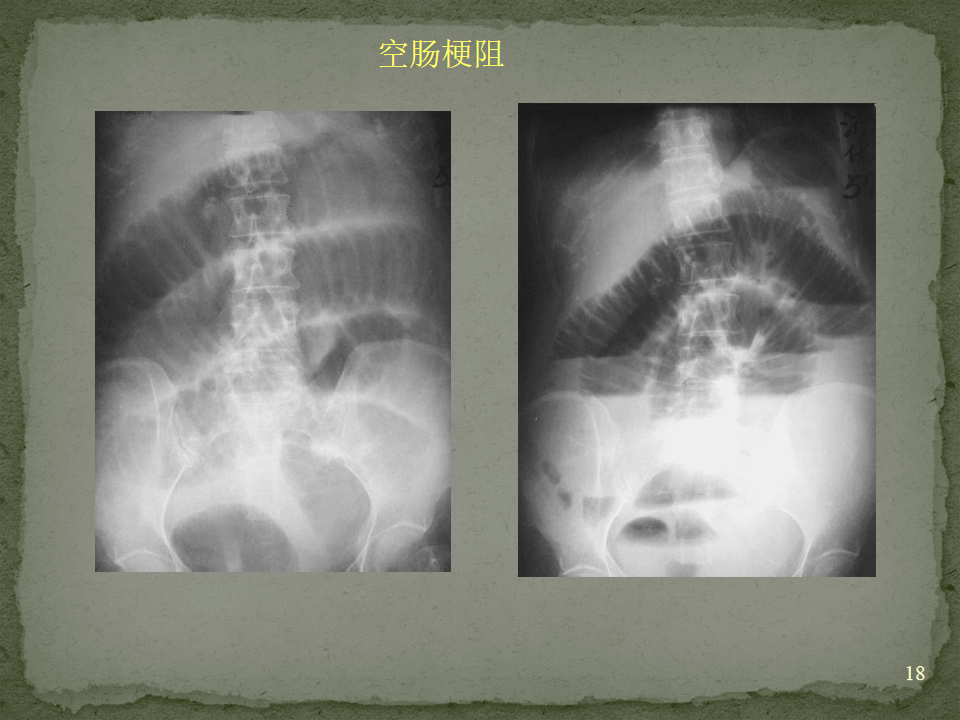 空肠梗阻鱼肋征图片图片