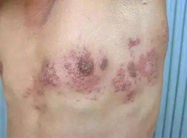 单纯疱疹和带状疱疹辨别和用药