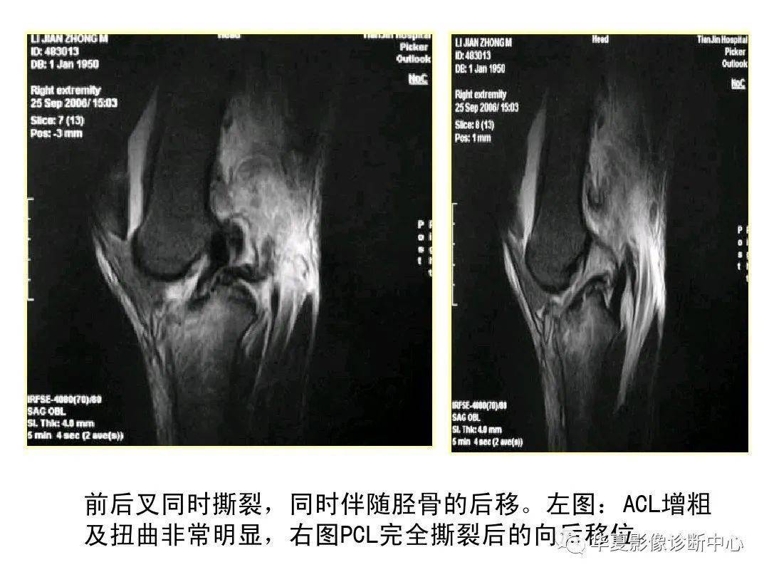 膝关节核磁前交叉韧带图片