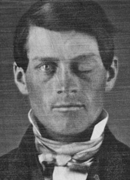 这位年轻病人的名字,叫做菲尼斯 · 盖奇(phineas gage).