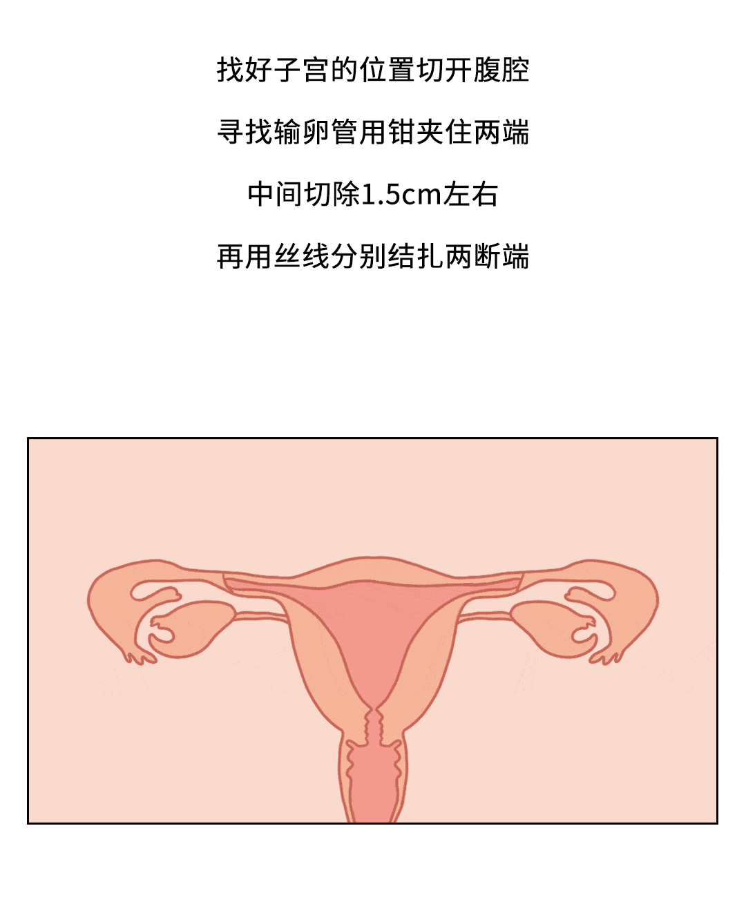 女性结扎开腹 输卵管图片