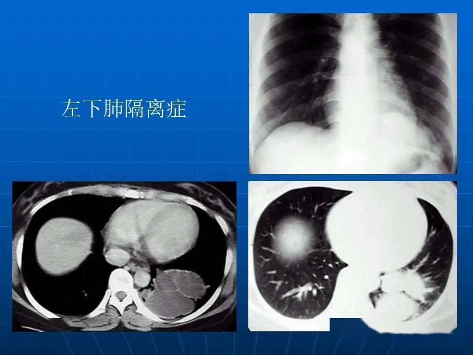 肺隔离症ct图片