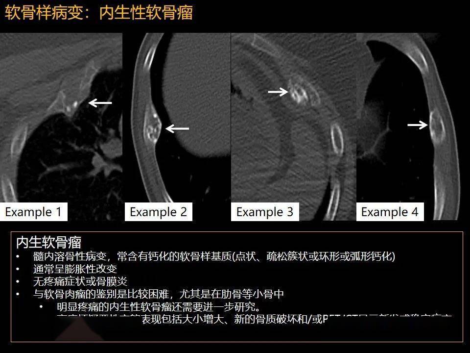 肋骨腫瘤腫瘤樣病變及獲得性非創傷性病變的影像診斷基本思路