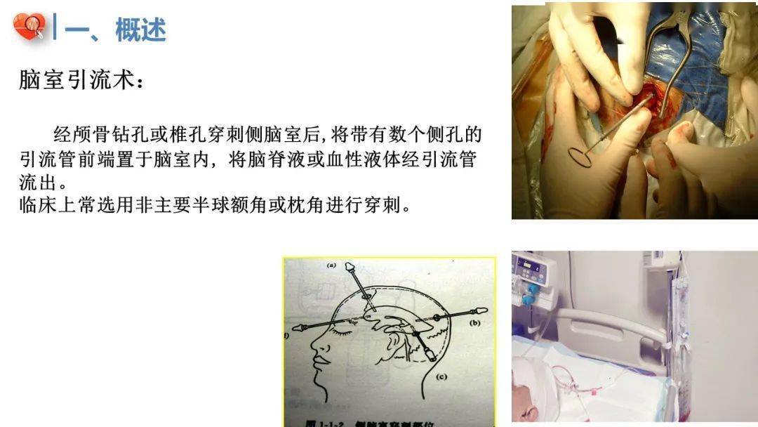 ppt脑室引流管的护理