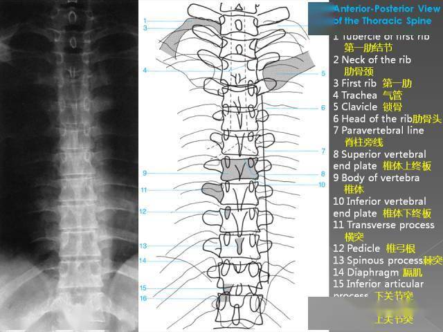 腰椎x线阅片法1,正位片腰椎正位片,可显示腰椎有无侧凸,两侧横突大小