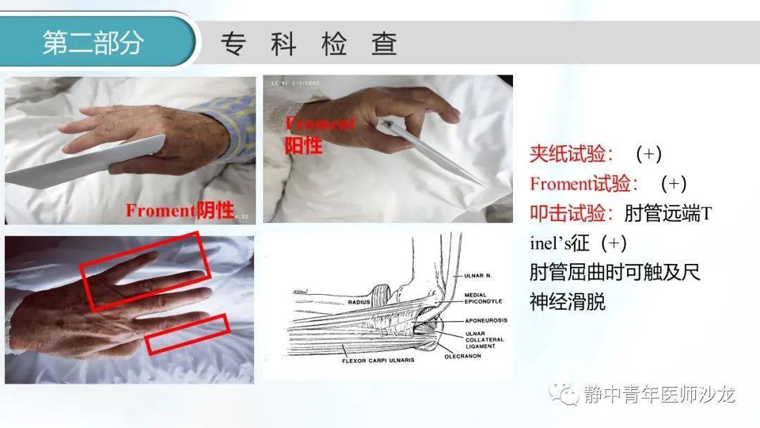 【原創】肘管綜合徵一例_張偉偉