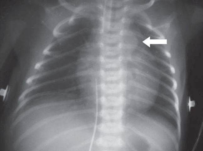 解读新生儿胸部x线这2个要点不得不知