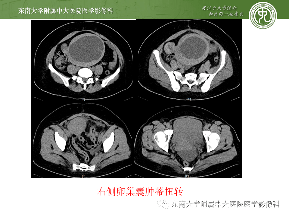下腹痛3小时"入院影像学表现超声ct编辑/校对:郑孝飞病例结果:宫外孕