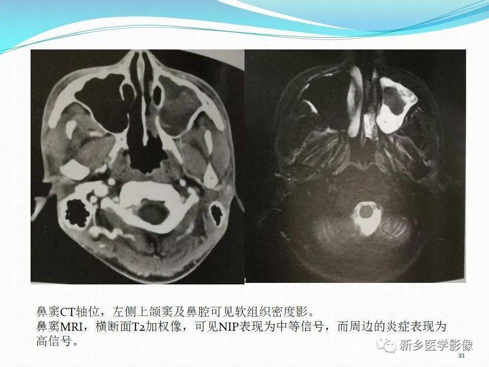 鼻内翻性乳头状瘤