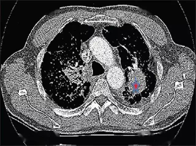 大塊纖維化(pmf)progressive massive fibrosis:pmf也被稱為複雜矽肺