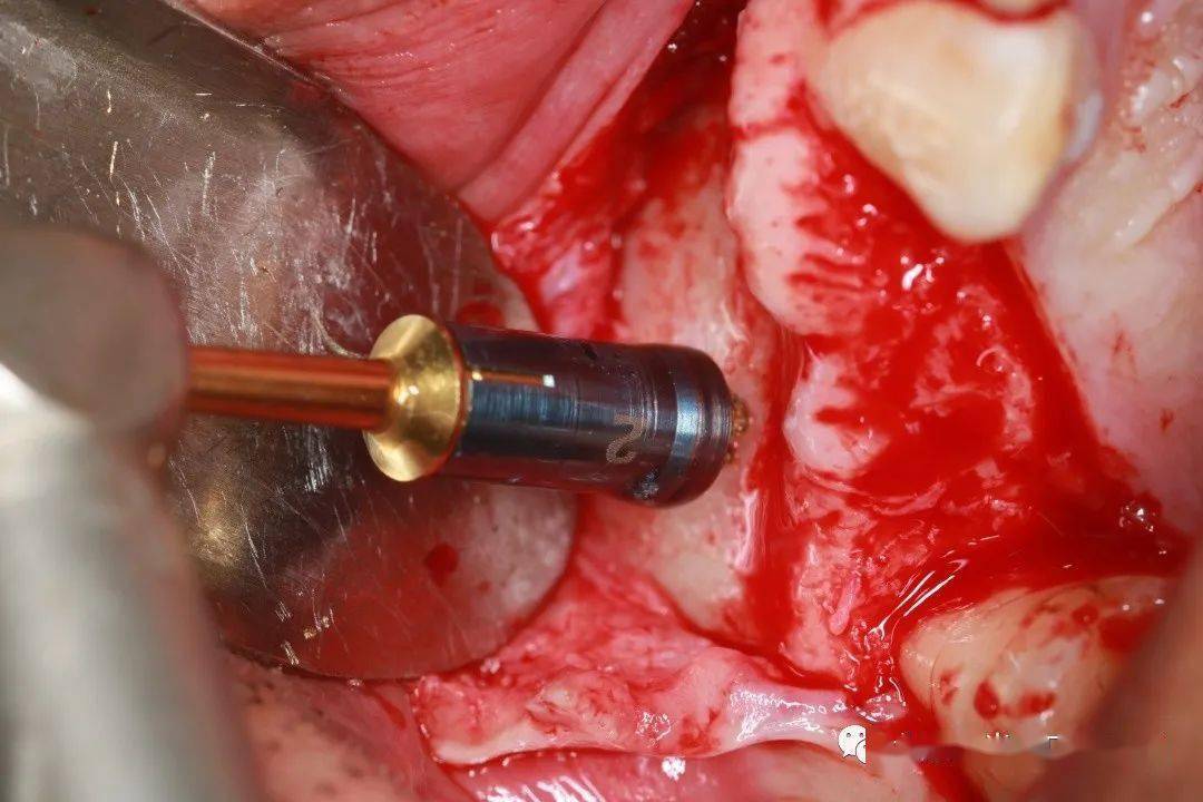 【牙医学堂】上颌窦清扫术后一年半做外提_梁光强