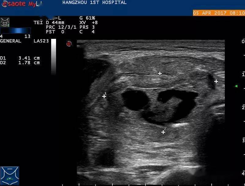 病例分享甲状腺囊性结节的消融治疗