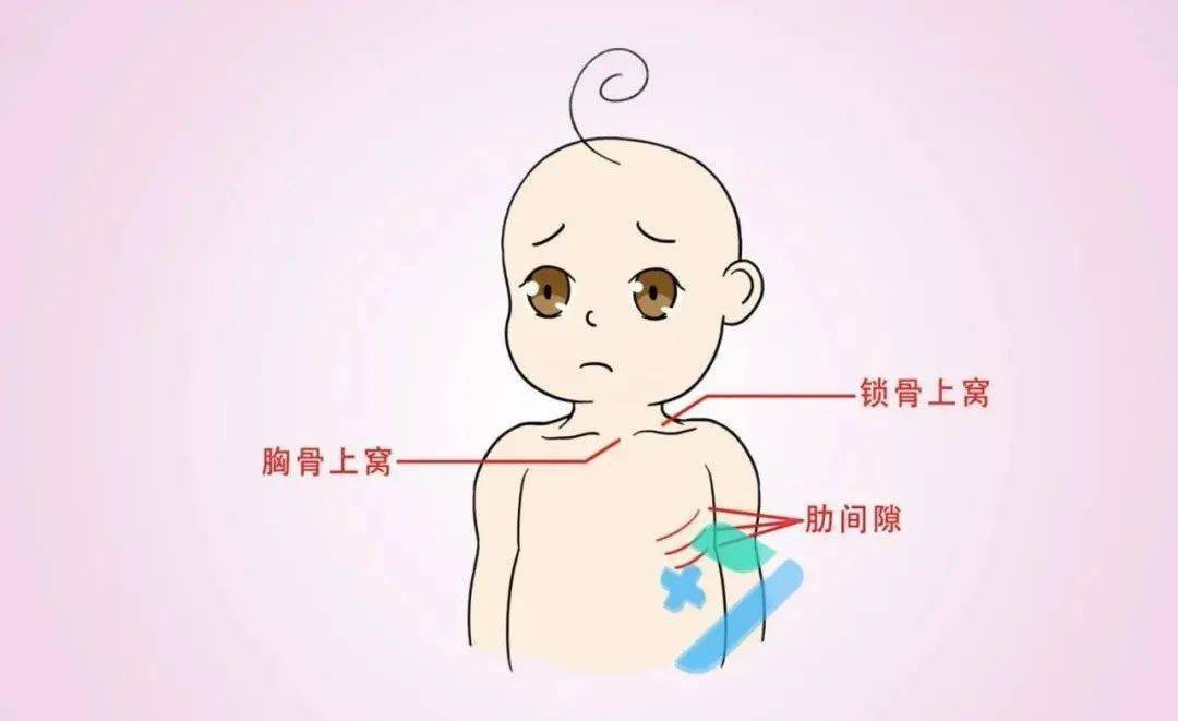 婴儿呼吸凹陷图片