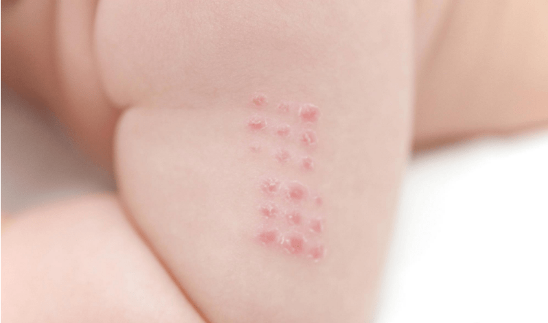 日本接种卡介苗的器具及疤痕中国接种的卡介苗疤痕接种疫苗后抗体可以