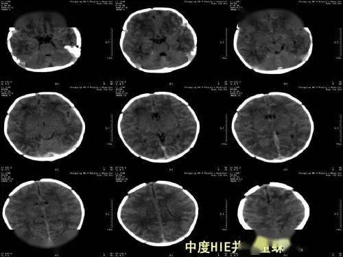 育儿学堂新生儿缺氧缺血性脑病