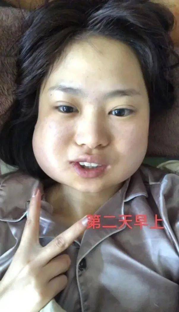 智齿可以一次性拔掉4颗吗有网友一次拔掉3颗然后亲妈都认不出来了