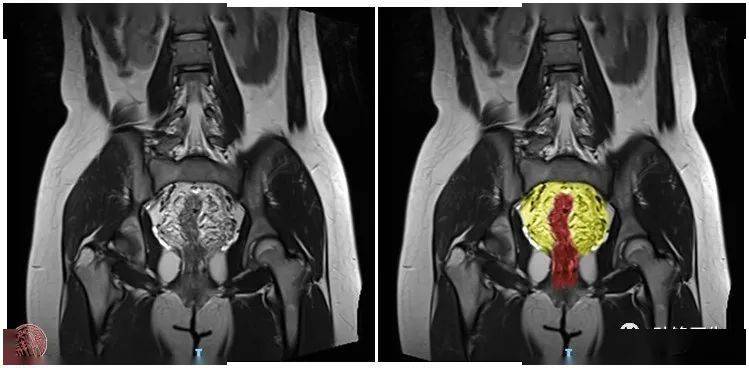 圖(9):盆腔冠狀位t2wi核磁影像↑↑↑圖(10):盆腔矢狀位t2wi核磁影像