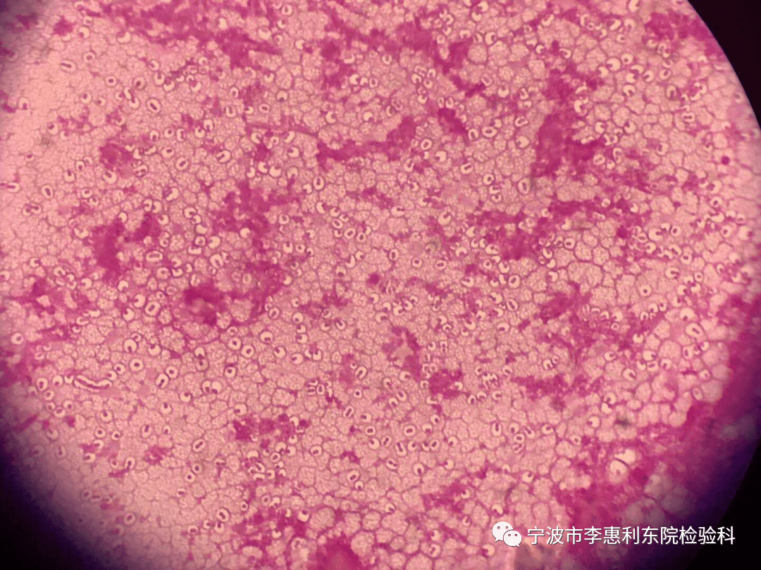 检验知多少高毒力肺炎克雷伯菌侵袭性感染病例分享