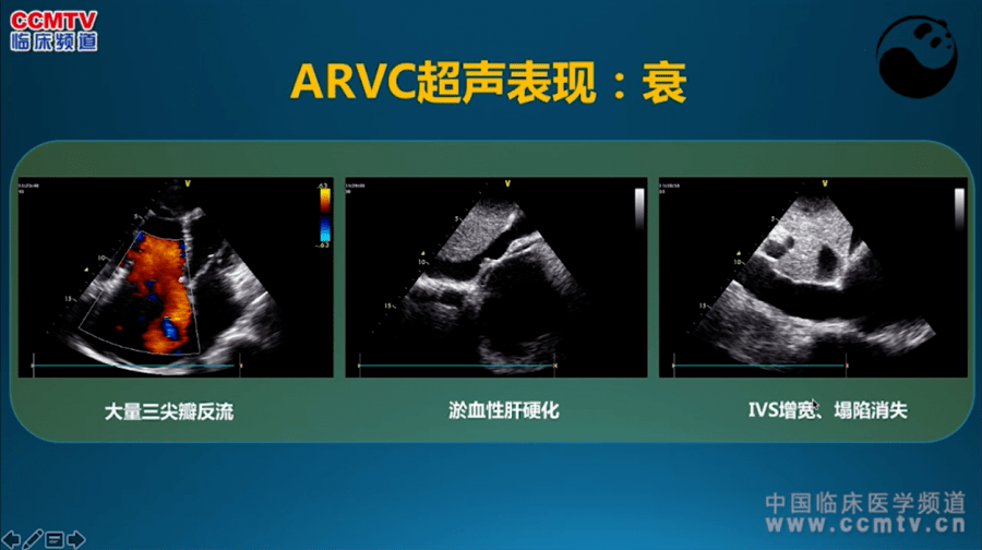 5步法读懂超声心动图,90%的医生都不知道!_心脏