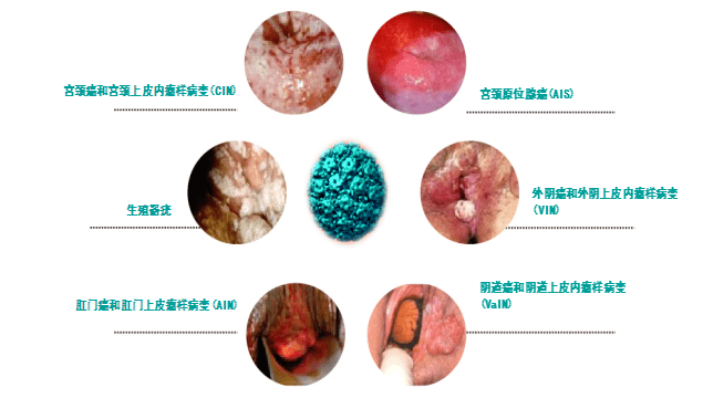 三针hpv疫苗不能在半年内打完是白打了吗