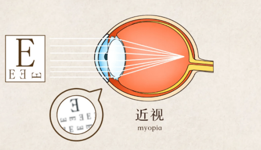 如何让眼睛视力降低 af203c56b9b64b7eaa6a5269a10e28c3.png