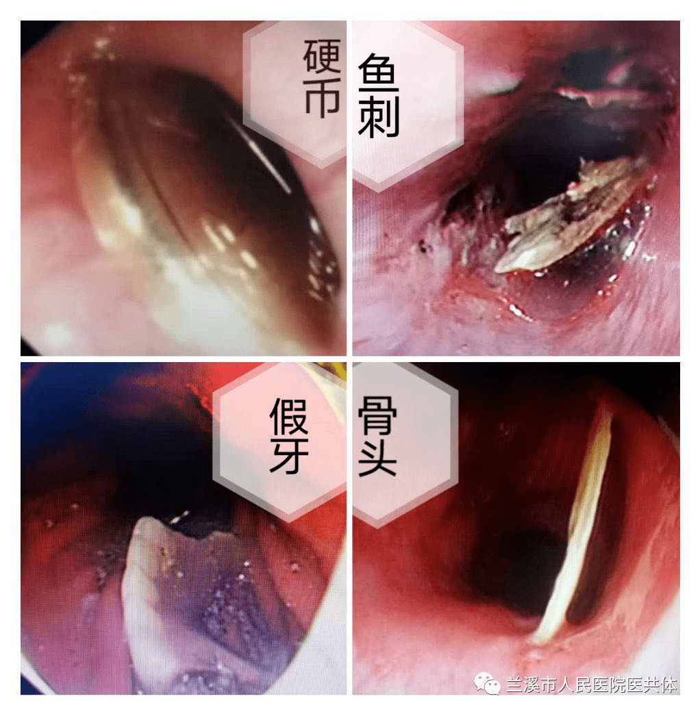 2分钟兰人医消化内科为三岁幼童取出食管异物