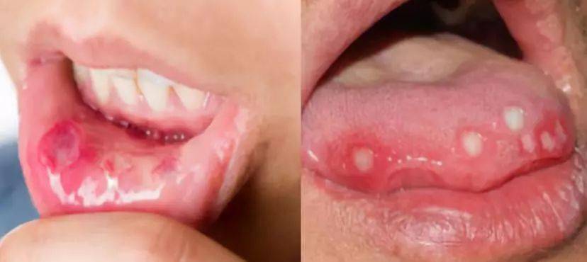 别忍口腔溃疡了法国人有妙招10秒止痛当天见效根源修护防复发