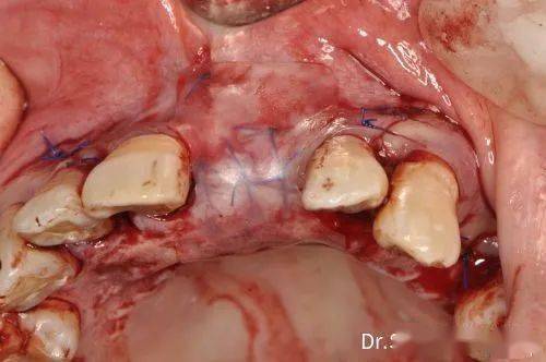 切牙孔多生牙拔除水平骨增量