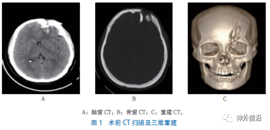 眉骨骨折图片ct图片